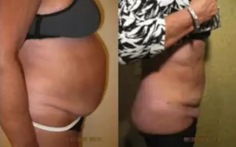 liposuction in washington dc