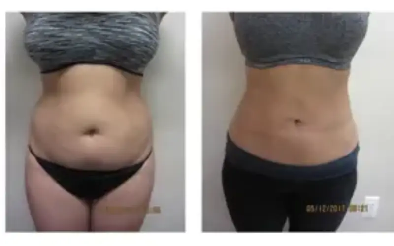 Enhance Your Silhouette with Liposuction In Washington, DC