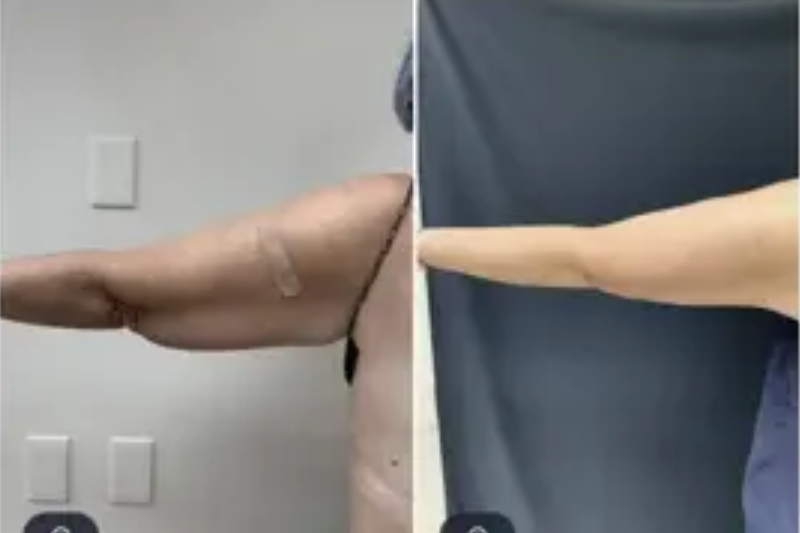 Say Goodbye To Stubborn Fat: DC Laser Liposuction