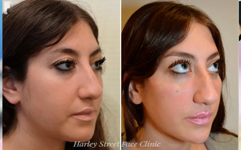 dermal fillers harley street
