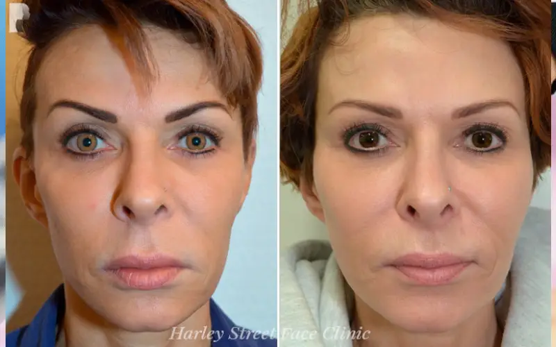 Achieve Your Perfect Look With Dermal Fillers On Harley Street