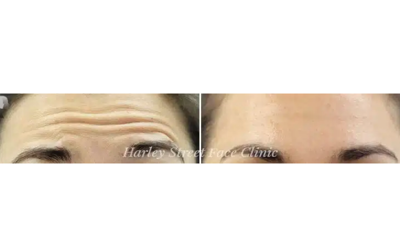 dermal filler london