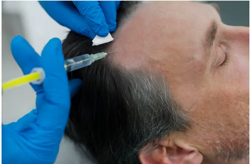 Hair Transplant in Turkey