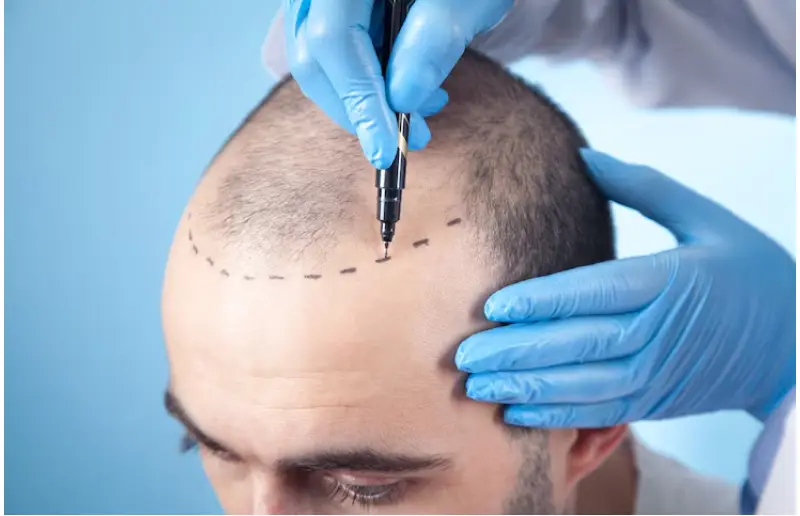 Where To Get Hair Transplants In Istanbul With English Help?